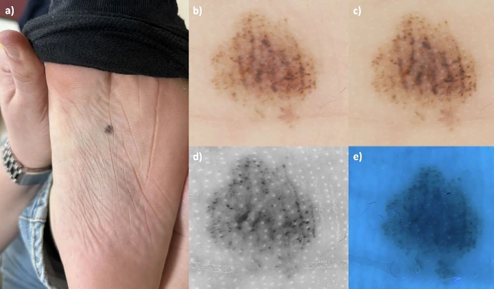 Nævus acral observé en dermoscopie polarisée, en lumière sub-UV et en fluorescence UV