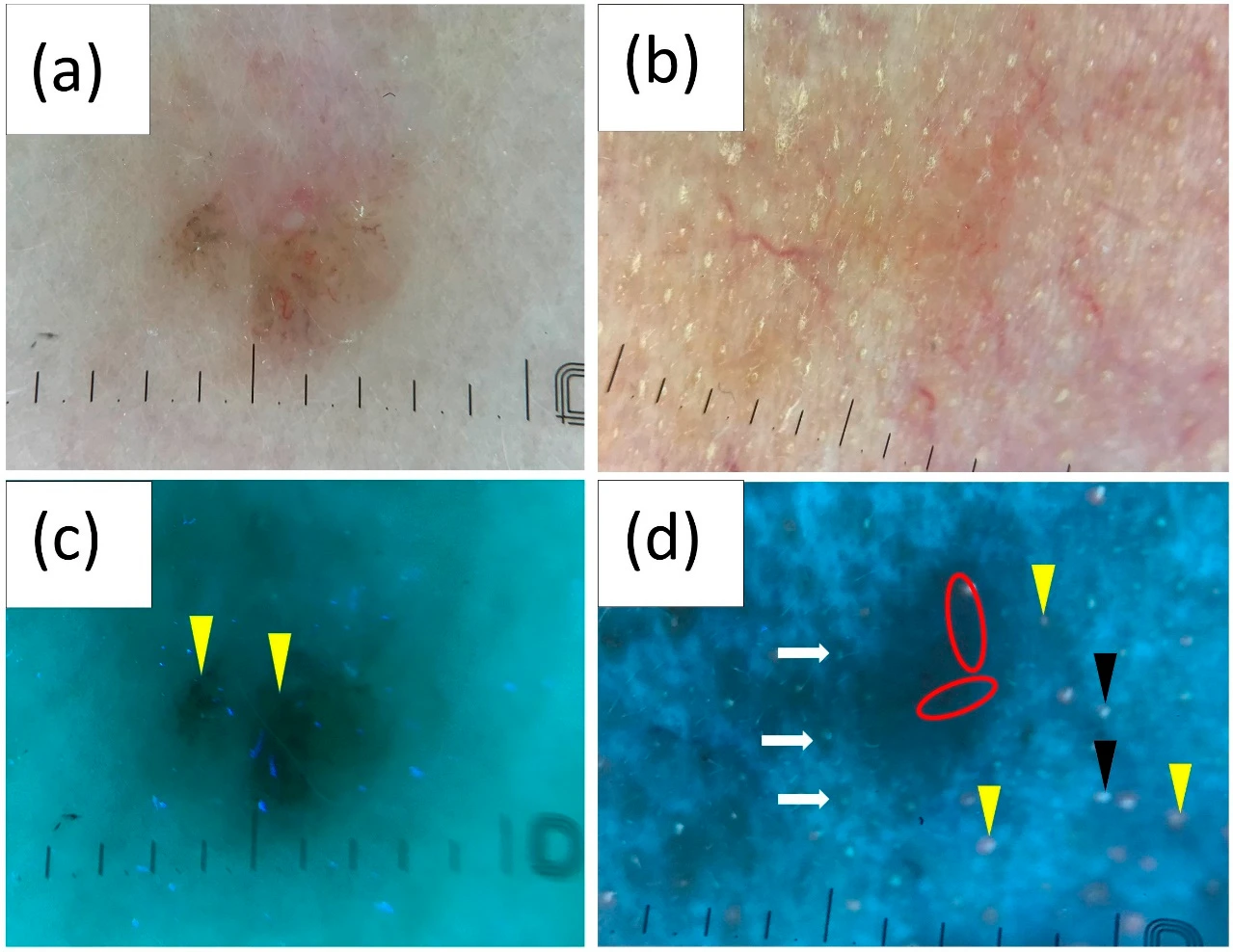 Carcinome basocellulaire en dermoscopie polarisée et en fluorescence UV