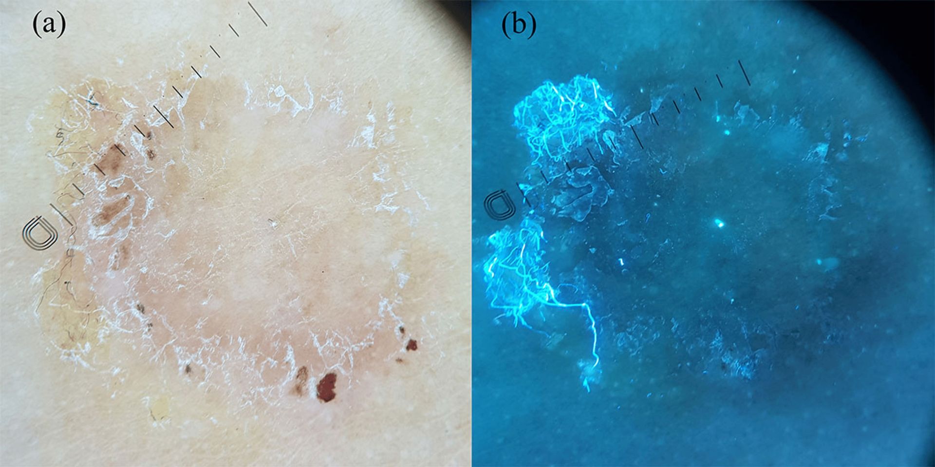 Teigne du corps en dermoscopie polarisée et en fluorescence UV