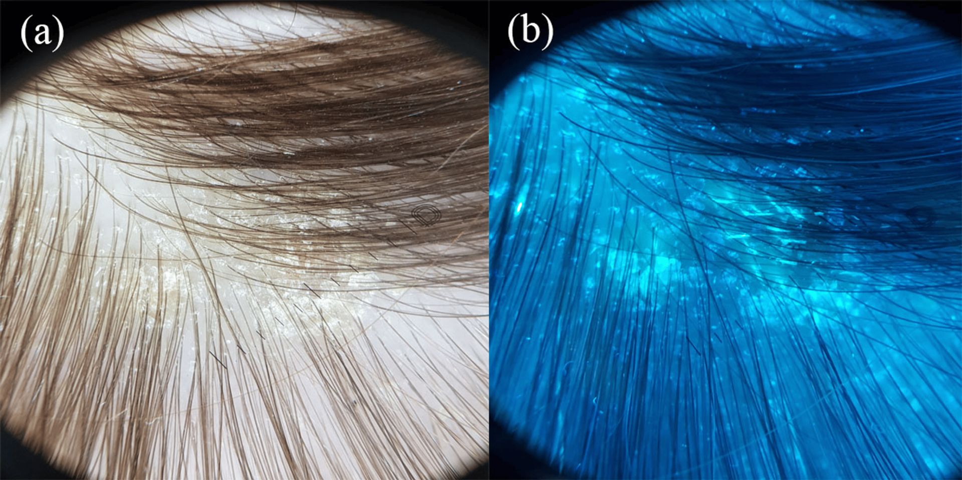 Teigne du cuir chevelu avec fluorescence verte en dermoscopie UV
