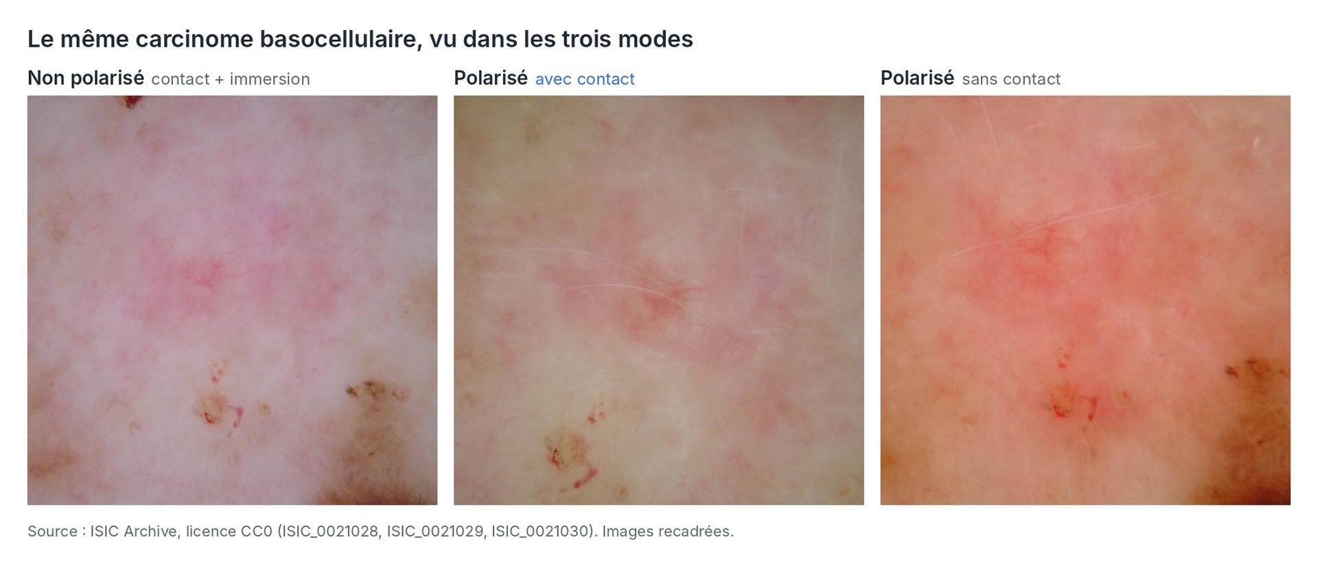 Le même carcinome basocellulaire photographié en non polarisé avec immersion, en polarisé au contact et en polarisé sans contact