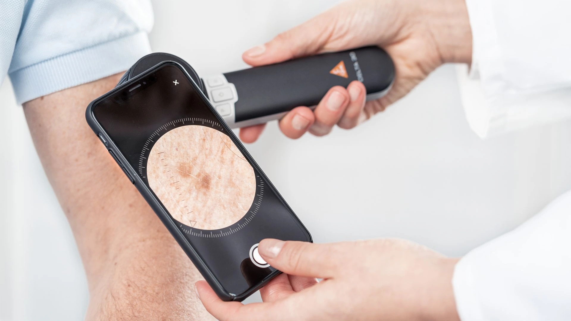 dermatoscope avec téléphone